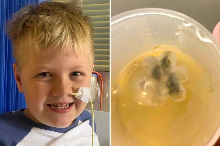 Marley Enjakovic (8 tahun) menjalani operasi untuk mengeluarkan mainan plastik yang tersangkut di tenggorokannya, sehingga membuat dia menderita batuk selama lima tahun.