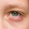 9 Penyebab Mata Bengkak dan Cara Mengatasinya