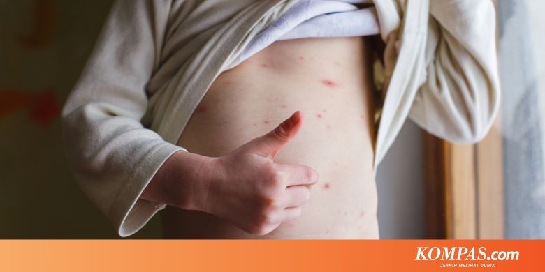 Apa yang Boleh dan Tidak Boleh Dilakukan Saat Kena Cacar Air?