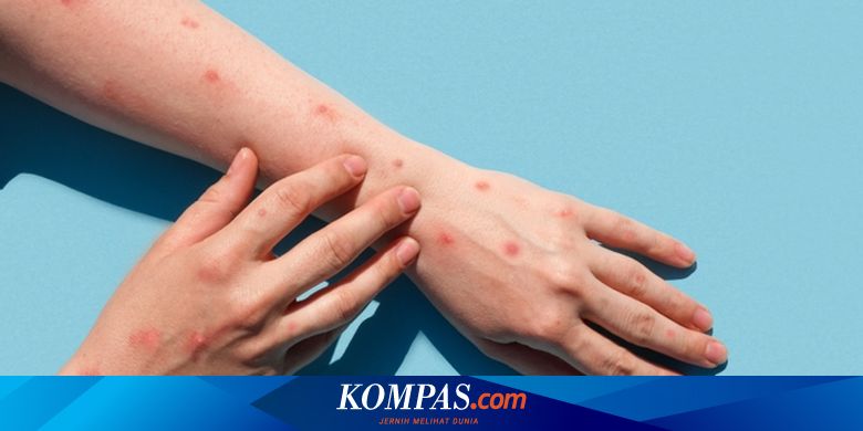 Monkey Pox Cases in DKI Jakarta: Symptoms, Treatment, and Prevention