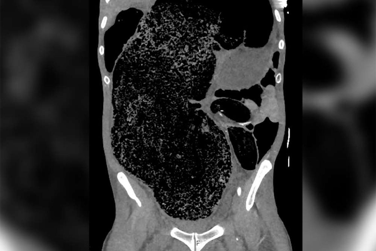 Hasil scan perut seorang pria di Australia