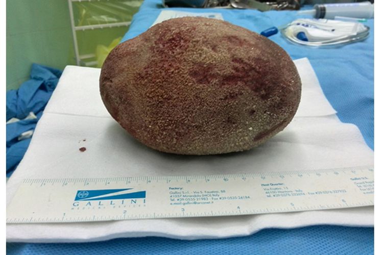 Tangkapan layar dari Jurnal Nephro-Urology Monthly soal seorang pria hanya mengeluh tidak nyaman di kandung kemih, tetapi dokter menemukan batu saluran kemih raksasa seberat 826 gram yang tumbuh diam-diam tanpa gejala berat.