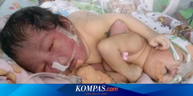 Seorang Ibu Melahirkan Bayi Kembar Siam Perut Di Kamar Mandi