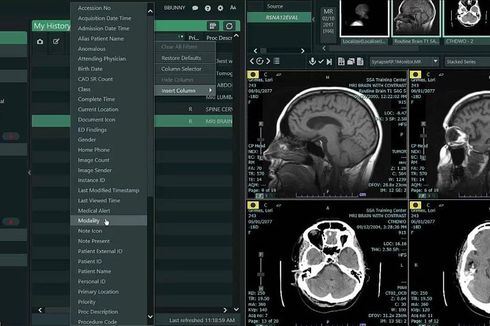 Teknologi Terkini Percepat Penanganan Pasien Stroke