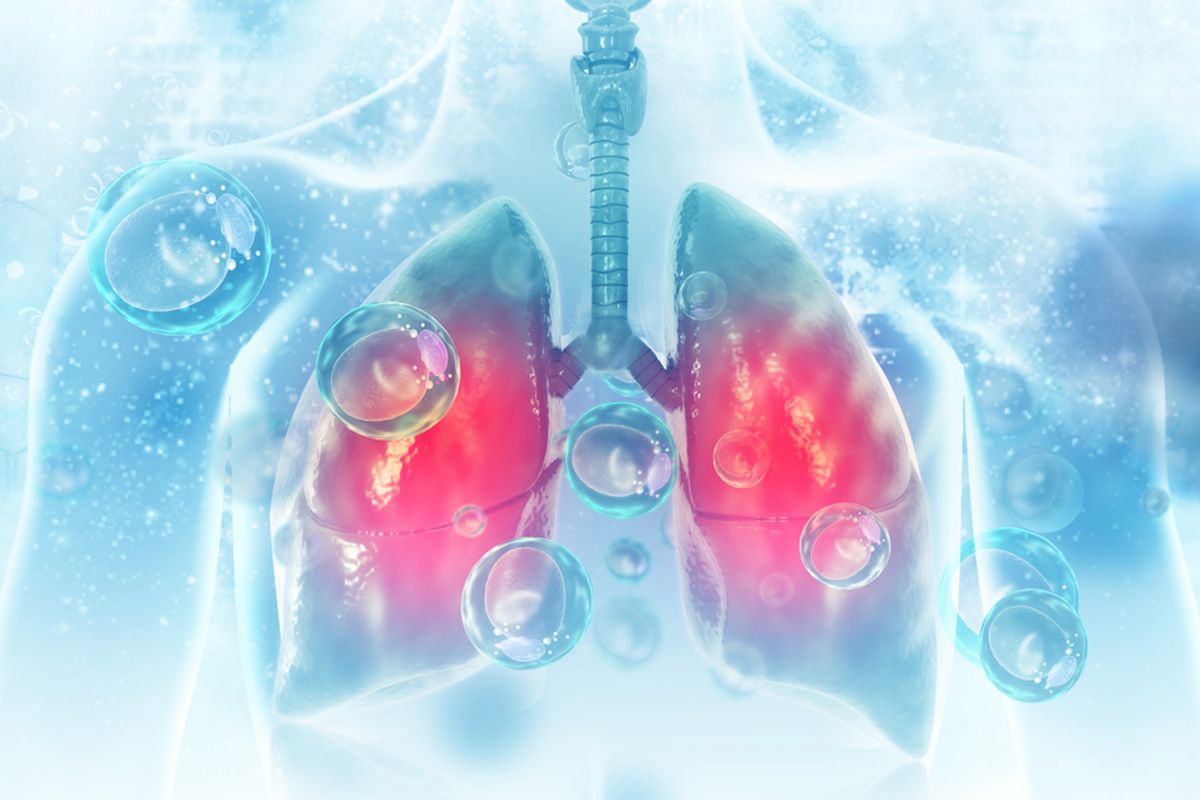 Ilustrasi CT scan (pemindaian) dada (paru-paru) tunjukkan pneumonia, virus corona penyebab Covid-19.