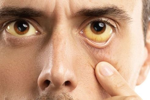 Penyebab dan Cara Mengatasi Mata Berwarna Kuning