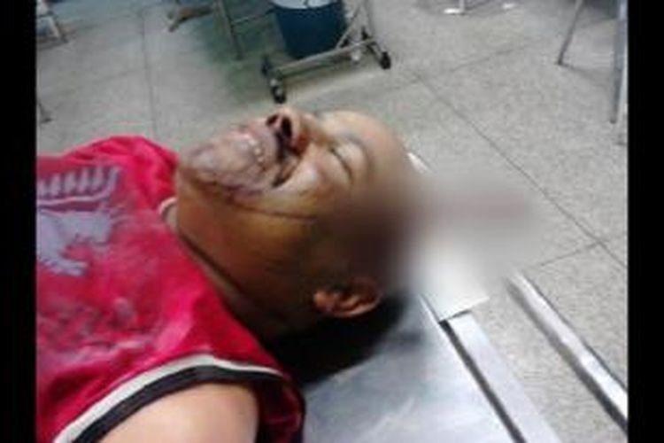Juacelo Nunes de Oliveira (39) tergeletak di sebuah ranjang rumah sakit sebelum operasi pencabutan pisau yang menancap di kepalanya digelar.