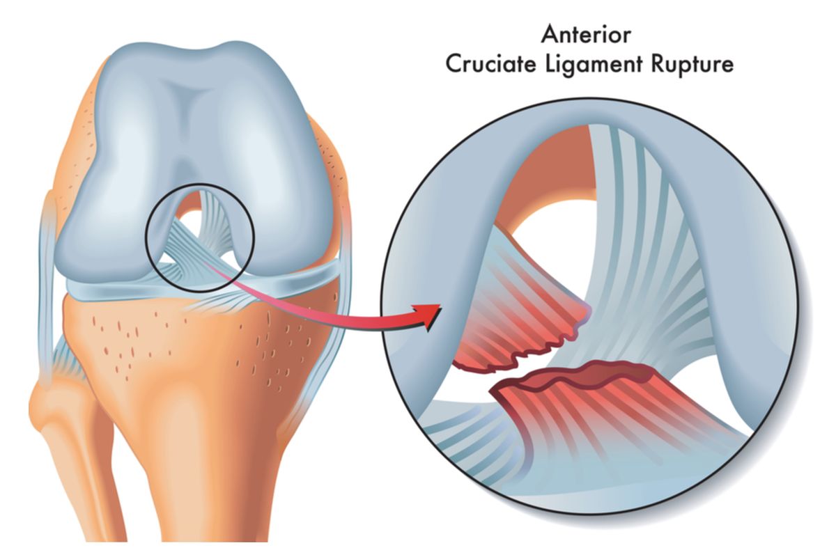 Ilustrasi cedera ligamen lutut anterior