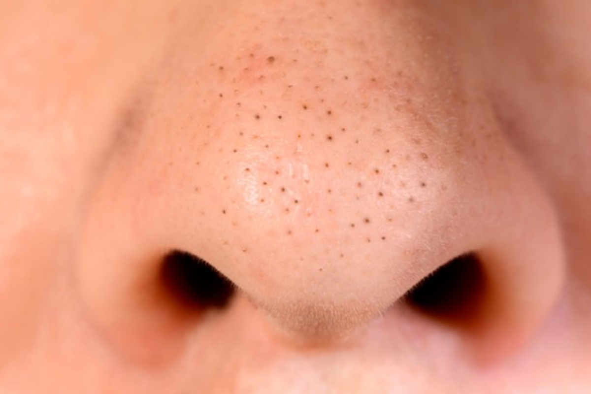 jerawat atau komedo blackhead