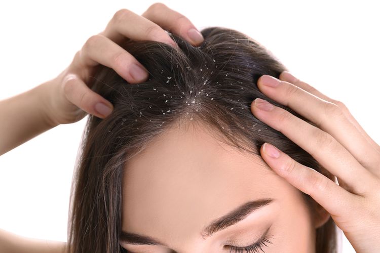 Munculnya ketombe adalah salah satu efek tidur dengan rambut basah.