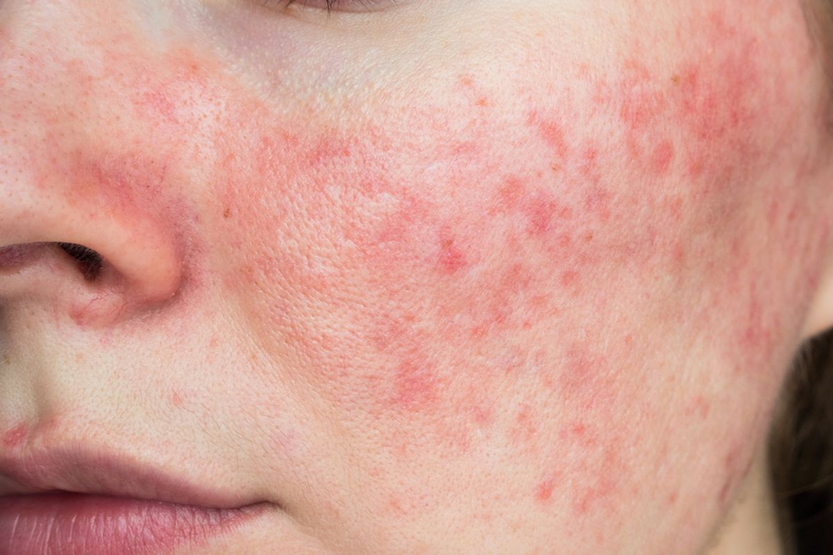 Mengetahui apakah rosacea menular atau tidak sangatlah penting untuk melakukan tindakan pencegahan yang diperlukan.