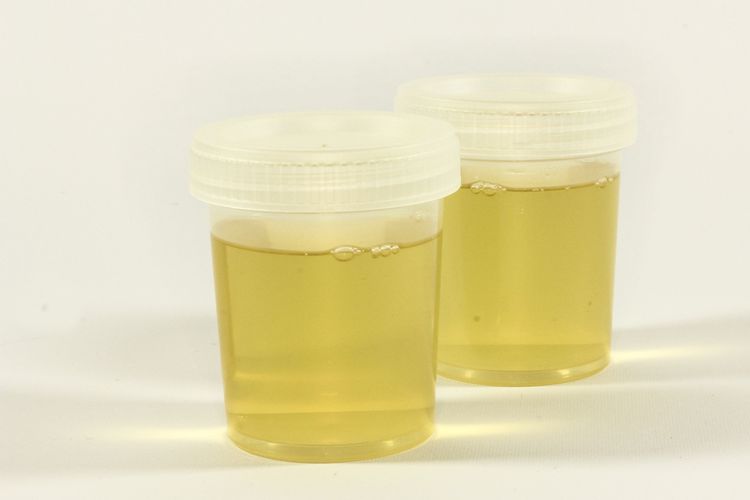Ilustrasi urine. Tidak ada penelitian ilmiah yang membuktikan ada manfaat minum urine. Justru, ada sejumlah efek samping dari praktik minum urine, seperti dehidrasi dan infeksi. 