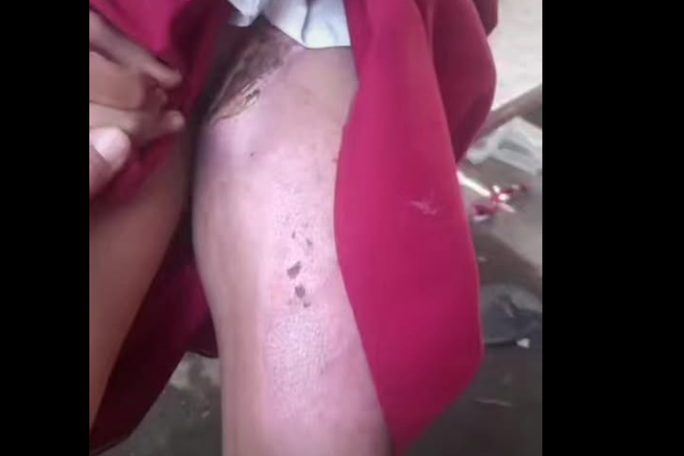 Tangkapan layar kaki anak di Jember yang melepuh karena disiram menggunakan air panas 
