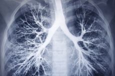 Mengenal Bronkoskopi Cryotherapy untuk Mengobati Penyakit Paru-paru