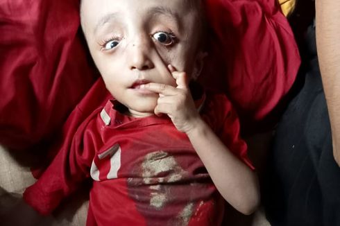 Derita Arif, 7 Tahun Alami Hidrosefalus dan Ditinggalkan Orangtuanya