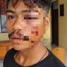 Dituding Sombong, Pemuda di Kupang Dianiaya hingga Wajah Robek