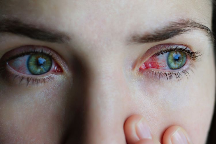 Ilustrasi sakit mata, peradangan mata. Banyak orang di Afrika meyakini sakit mata dapat diobati dengan air kencing. Namun, hingga saat ini belum ada bukti ilmiah. Praktik ini berbahaya, terutama jika dilakukan orang dengan gonore.