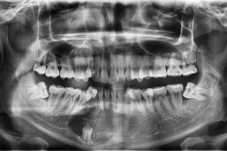 Ilustrasi Rontgen Panoramic rahang dan gigi