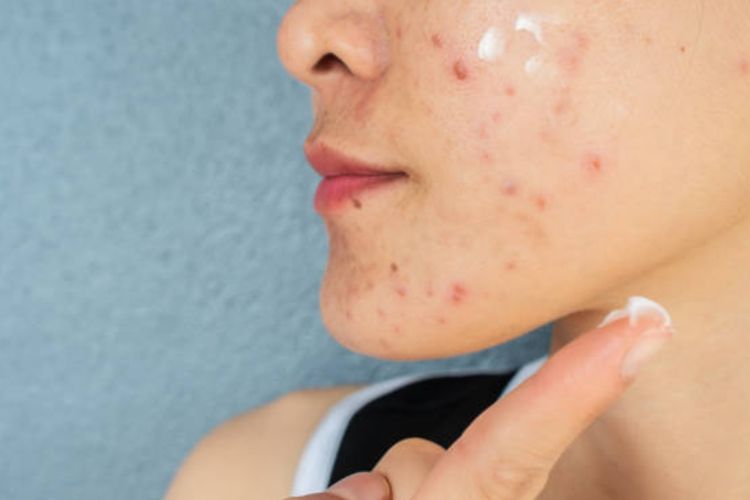 Mikroplastik bisa jadi alergen penyebab jerawat dan iritasi. Simak penjelasan dokter dan bagaimana menanganinya.