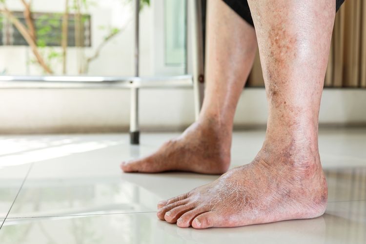 Ilustrasi kaki penderita diabetes. Jika Anda memiliki diabetes, kenalilah tanda-tanda luka kaki diabetes untuk mencegah infeksi dan amputasi. 