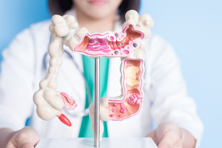 Ilustrasi kanker usus besar. Aktor ?Dawson?s Creek? wafat akibat kanker kolorektal, berikut tanda-tanda medis yang kerap tidak disadari.