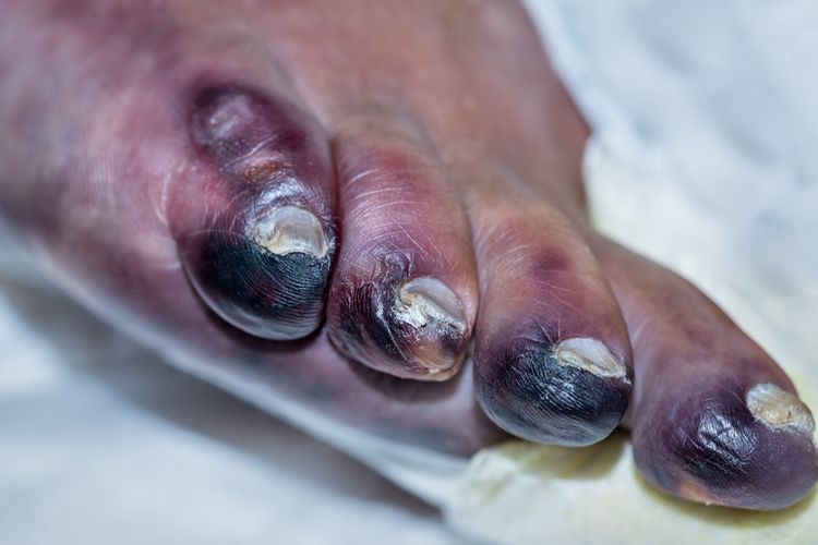 Ilustrasi gangren di jari kaki. Gangren adalah kondisi di mana darah berhenti mengalir ke bagian tertentu dari tubuh. Ini menyebabkan jaringan mati dan kulit berwarna hitam.
