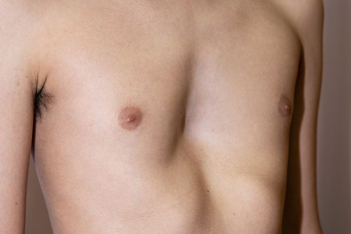 Ilustrasi Pectus Excavatum