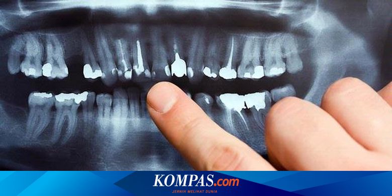 Dicabut Gigi Atas Tanpa Rontgen Amankah
