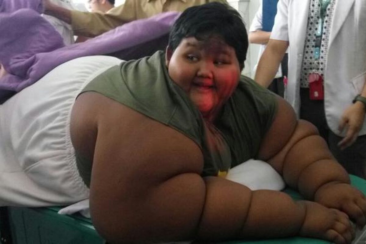 Arya Permana (10) penderita severe obesity ditangani 13 dokter spesialis RSHS. Berat badan normal Arya kurang dari 50 kg, namun saat ini beratnya mencapai 189,5 kg. 