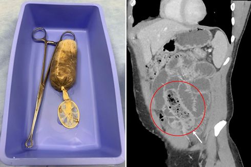 Makan Pisang Dibungkus Kondom, Pria Ini Alami Penyumbatan Usus Serius