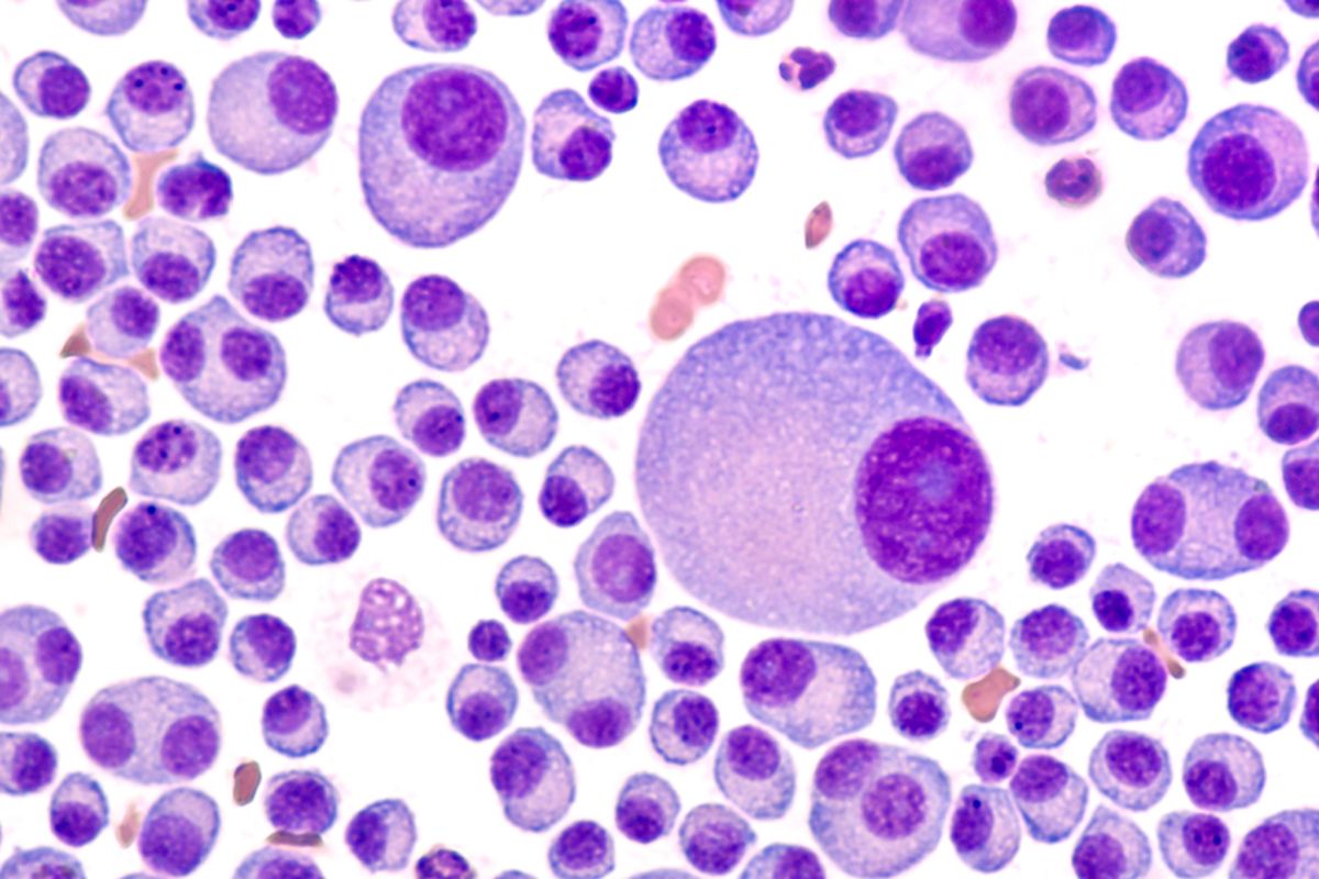 Ini adalah hasil aspirasi sumsum tulang yang menunjukkan multiple myeloma. Diagnosis multiple mieloma termasuk sangat menantang. 