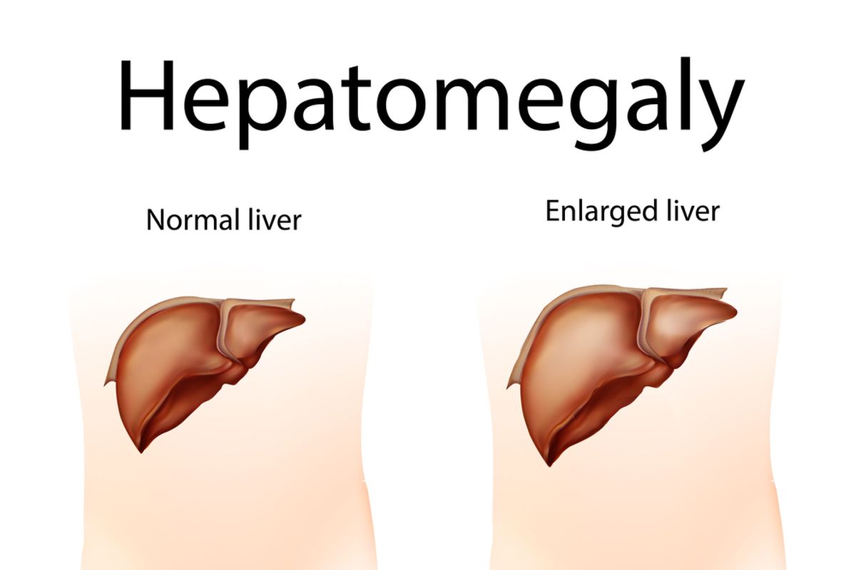 Ilustrasi Hepatomegali