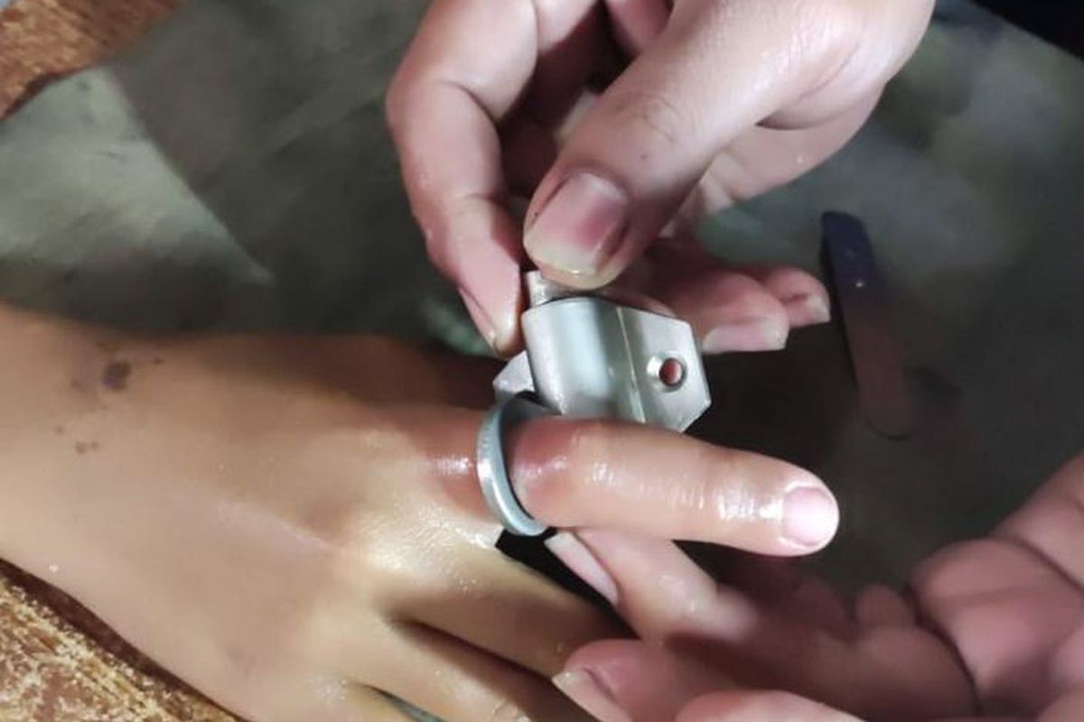 Jari telunjuk tangan kanan Muhammad Baim saat terjebak lubang pengunci jendela, yang kemudian dibantu petugas Damkarla Gresik mengeluarkan, Kamis (24/11/2022).