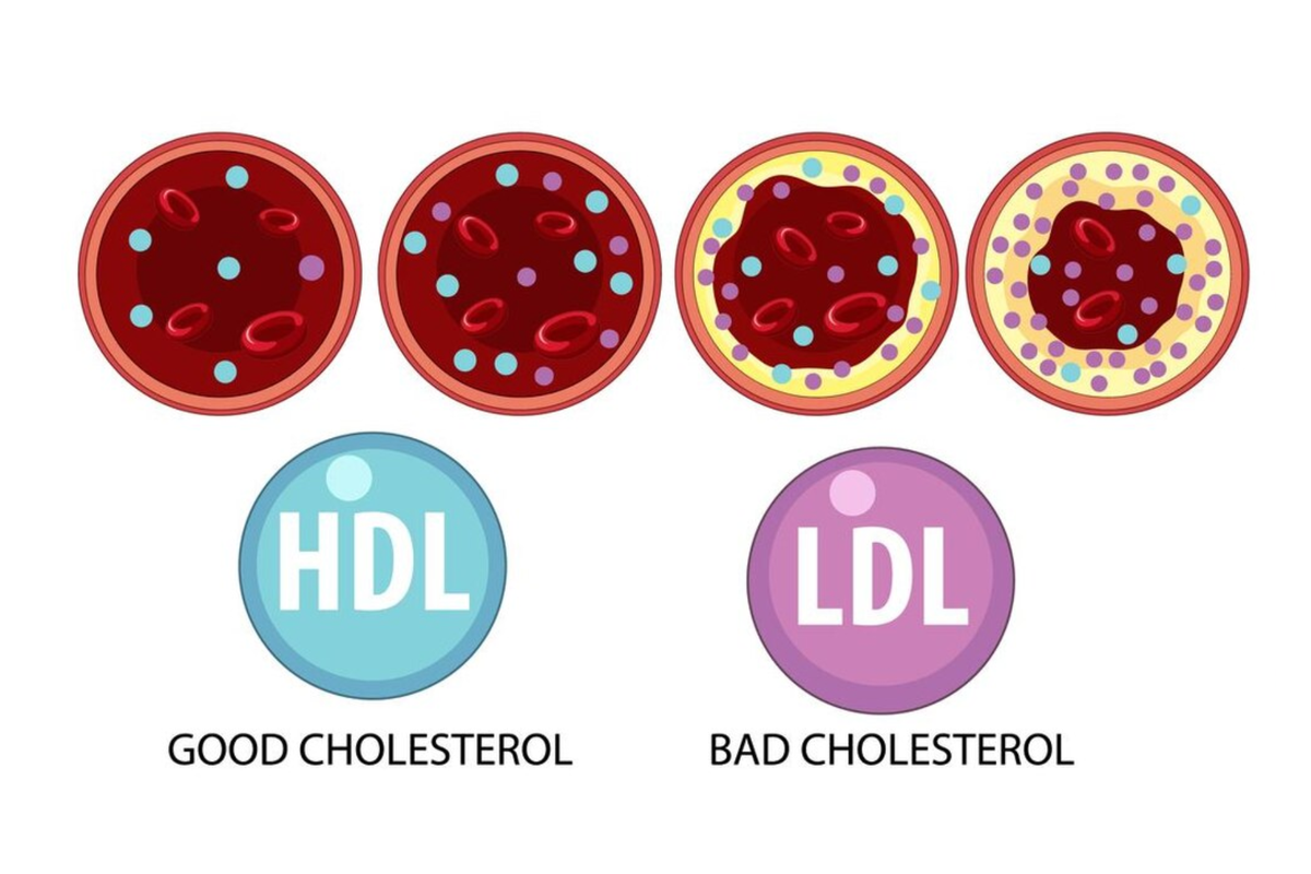 Beda kolesterol baik dan kolesterol jahat.