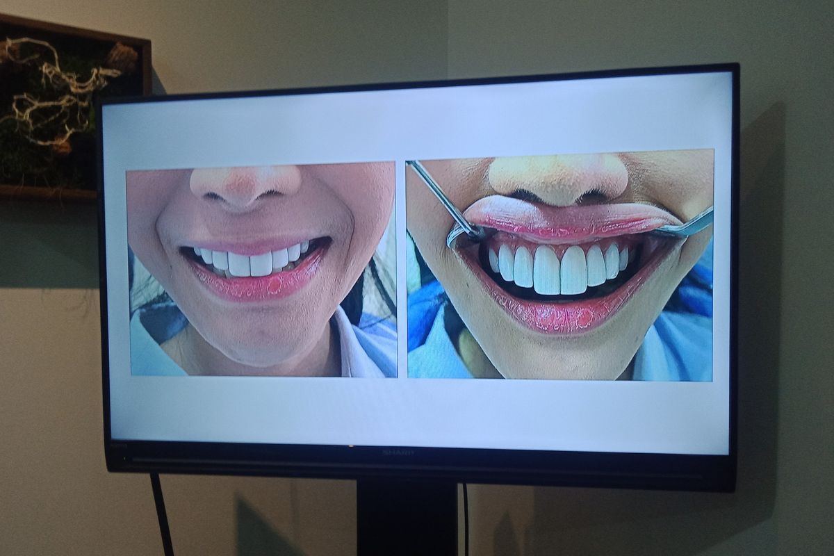 Contoh pasien veneer gigi di Indo Dental Center, Jakarta. Veneer gigi bukan asal putih atau asal berbentuk gigi kelinci, melainkan disesuaikan dengan kebutuhan setiap orang.