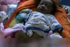 Ketinggalan Pesawat, Bayi Berkepala Dua Tertunda Pergi ke Jakarta