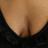 Penyebab Stretch Mark di Payudara, Cara Mencegah dan Mengatasinya