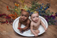 Bayi Kembar Ini Lahir dengan Warna Kulit Berbeda