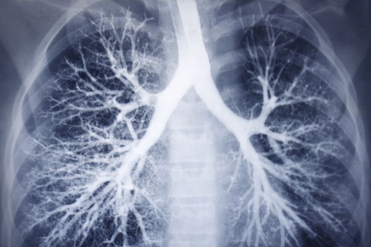 Ilustrasi bronkoskopi cryotherapy. Kenali apa itu bronkoskopi cryotherapy untuk mengobati penyakit paru dan saluran napas. 