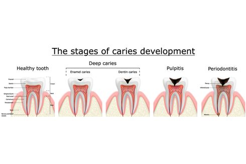 Pulpitis 