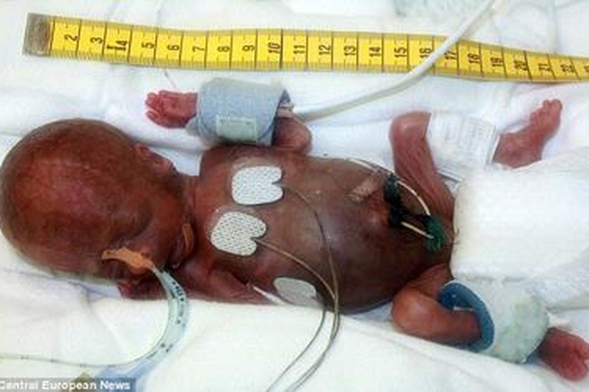 Tom Thum, bayi prematur dengan berat 275 gram, panjang 22 cm