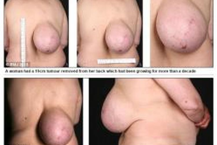 Pertumbuhan lipoma atau tumor jinak yang mirip payudara di punggung seorang wanita asal Dublin, Irlandia.