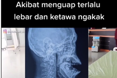 Viral Mulut Tak Bisa Ditutup Akibat Menguap Terlalu Lebar, Ini Penjelasan Dokter