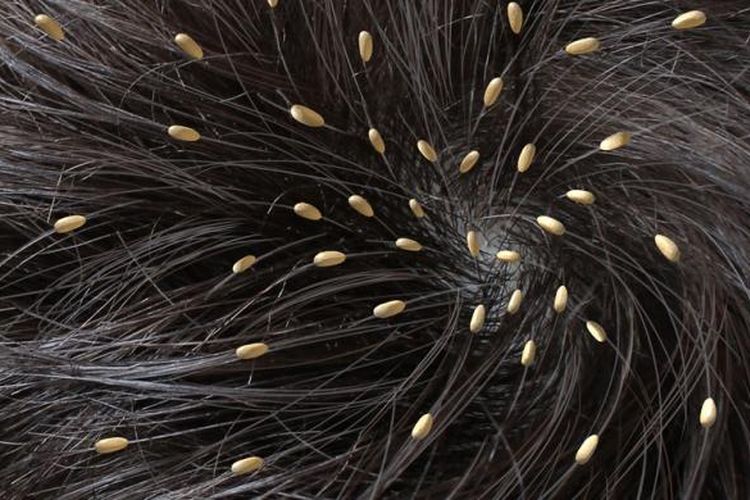 Ilustrasi kutu rambut pada anak. Ada cara aman untuk membasmi kutu rambut yang harus diperhatikan agra terhindar dari efek samping yang bisa membahayakan. 