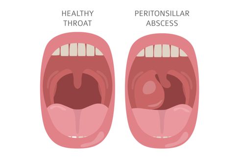 Abses Peritonsil