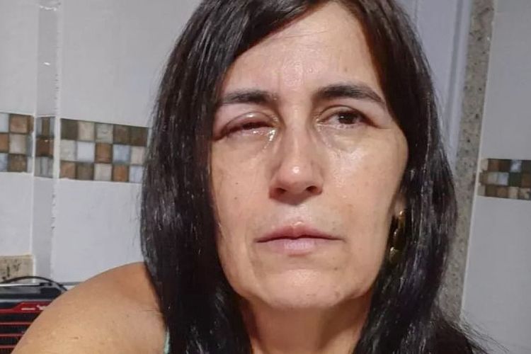 Regina Amorim, seorang wanita di Brasil yang harus dilarikan ke rumah sakit setelah matanya ditetesi lem super kuat oleh pacarnya, daripada obat mata untuk mengobati glaukomanya.