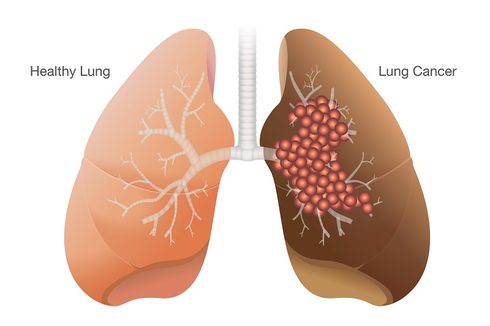 4 Gejala Kanker Paru-paru Sesuai Jenisnya