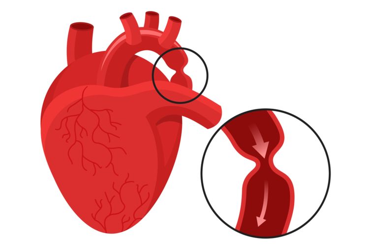 Ilustrasi koarktasio aorta