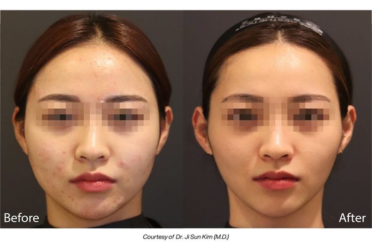 Hasil treatment dengan LINEAR Z.