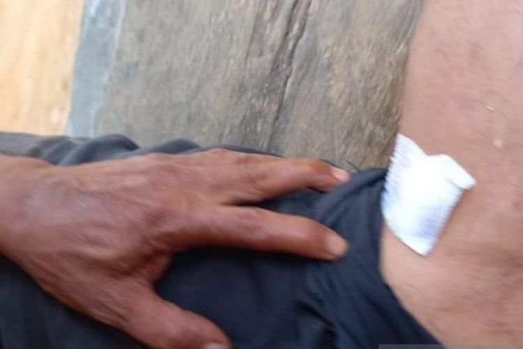 Ketua DPRD Bangka Iskandar mengalami luka akibat gigitan buaya di kaki kiri. 